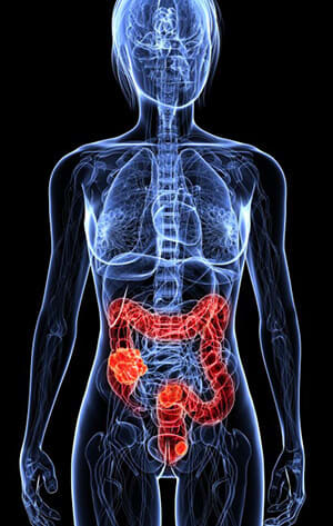 Chronic Inflammation